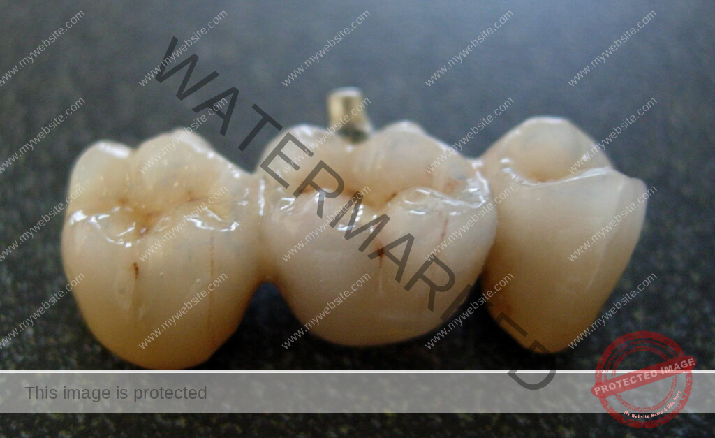 Ceramic Teeth Cap