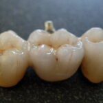 Ceramic Teeth Cap