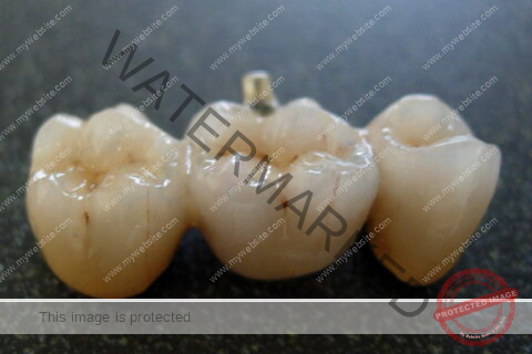 Ceramic Teeth Cap