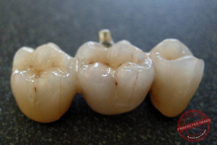 Ceramic Teeth Cap